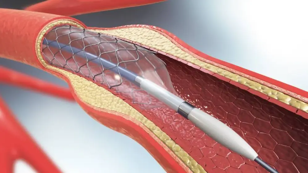 El stent se emplea para tratar las obstrucciones