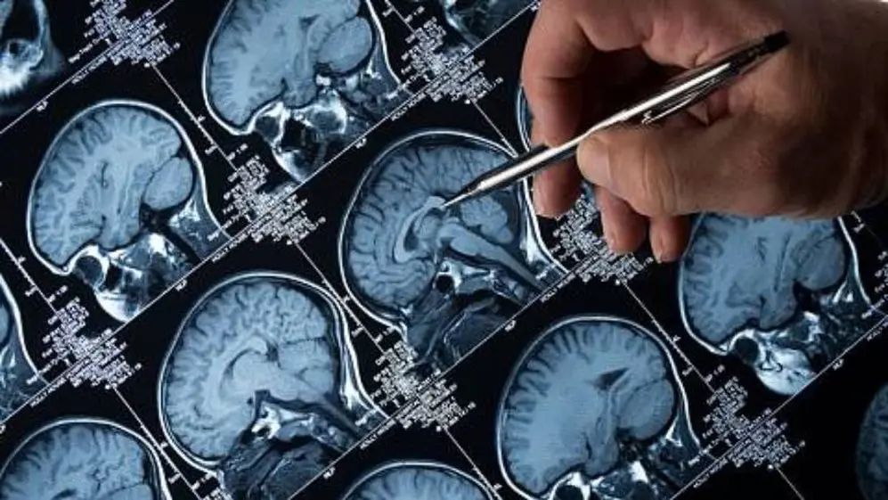 El implante se coloca en el cerebro
