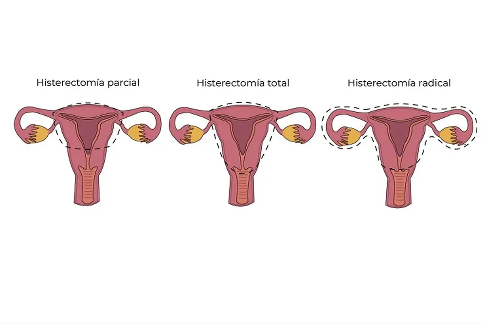 ¿Qué es la histerectomía?