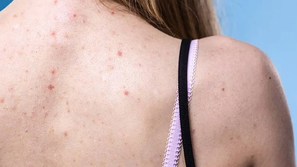 El acné puede aparecer en otras zonas del cuerpo, además del rostro
