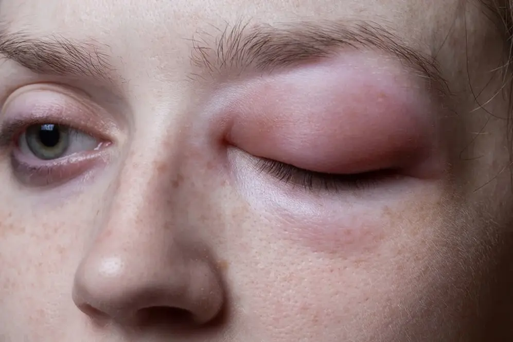 El angioedema hereditario afecta aspectos físicos, mentales, emocionales y sociales de los pacientes