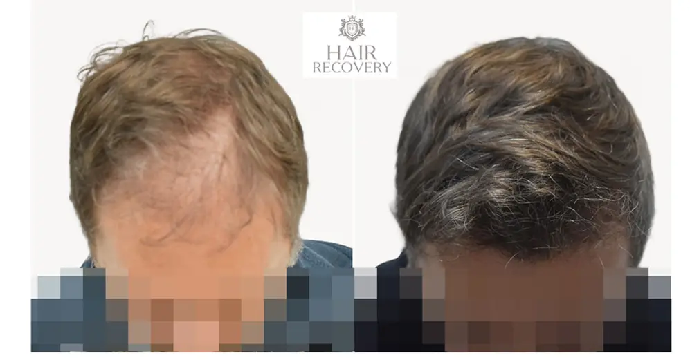 Hair Recovery: antes y después de un tratamiento.