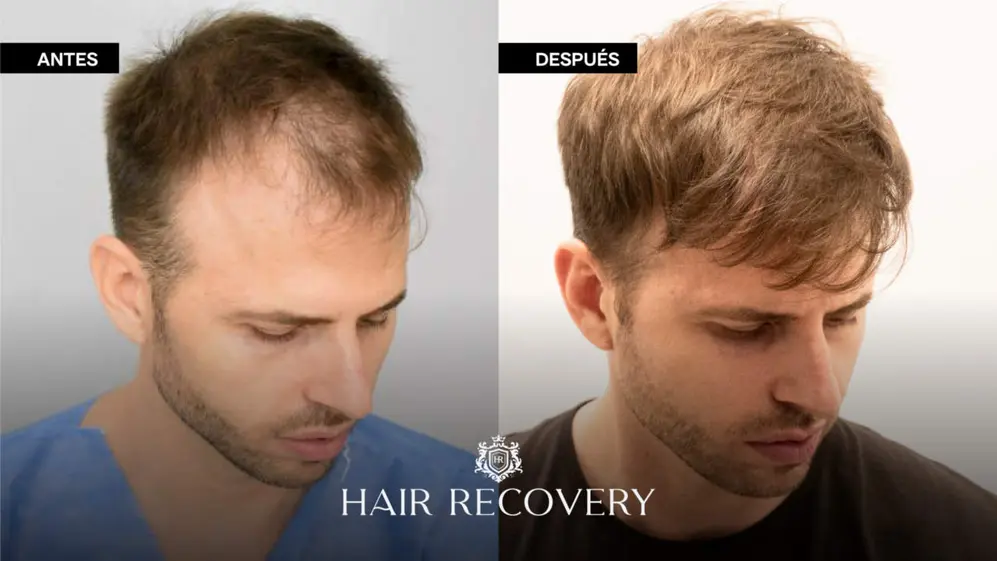 Antes y después de un microtrasplante capilar pelo por pelo