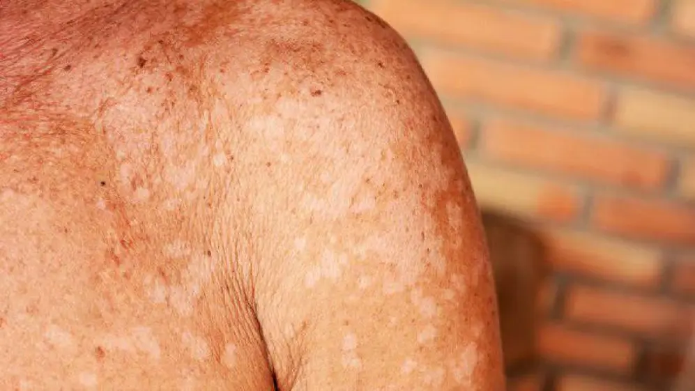 La hipomelanosis guttata es una de las causas de la aparición de manchas blancas en la piel