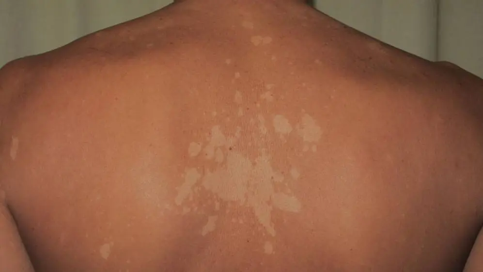 La pitiriasis versicolor puede causar la aparición de manchas blancas en la piel