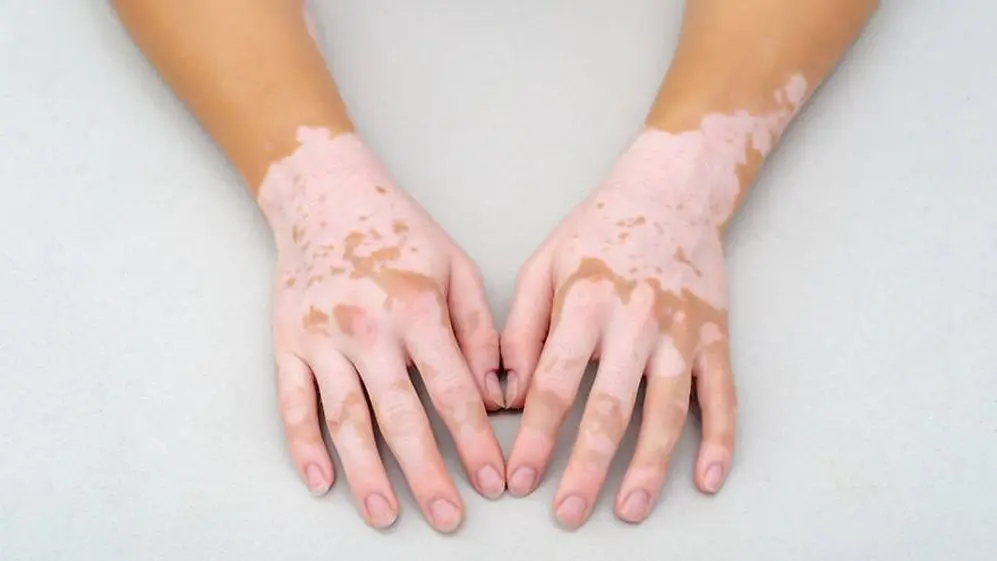 El vitiligo es otra de las causas de la aparición de manchas blancas en la piel