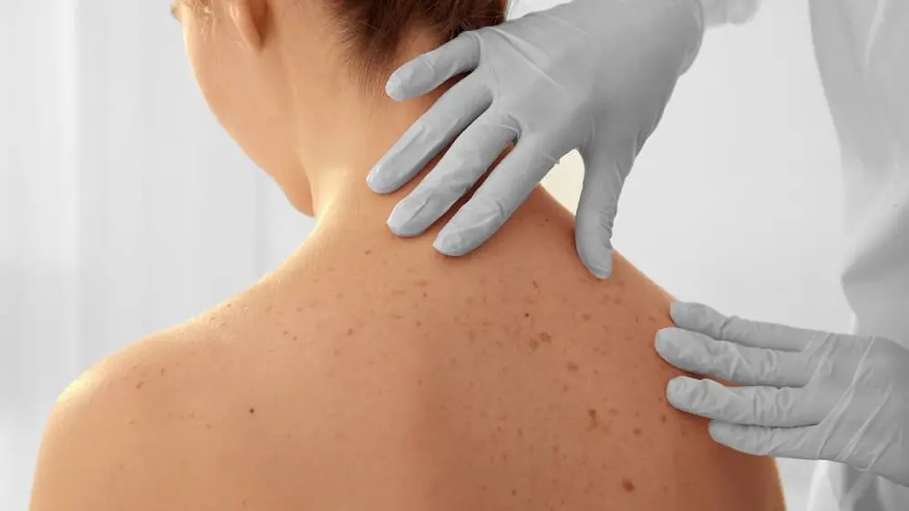 En caso de que aparezcan manchas blancas en la piel, es necesario consultar con un especialista para que las analice e indique qué hacer