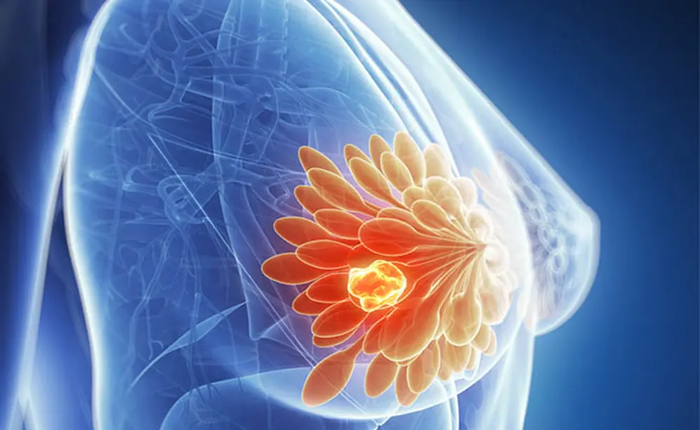 breastcancer